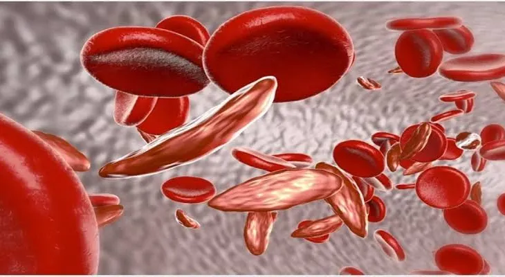 Over 4,000 Sierra Leoneans Diagnosed with Sickle Cell Disease