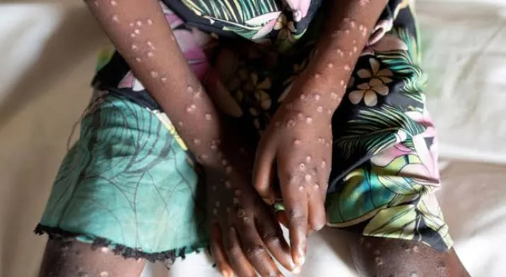 32-Year-Old Man Dies in Kono from Suspected Mpox Infection