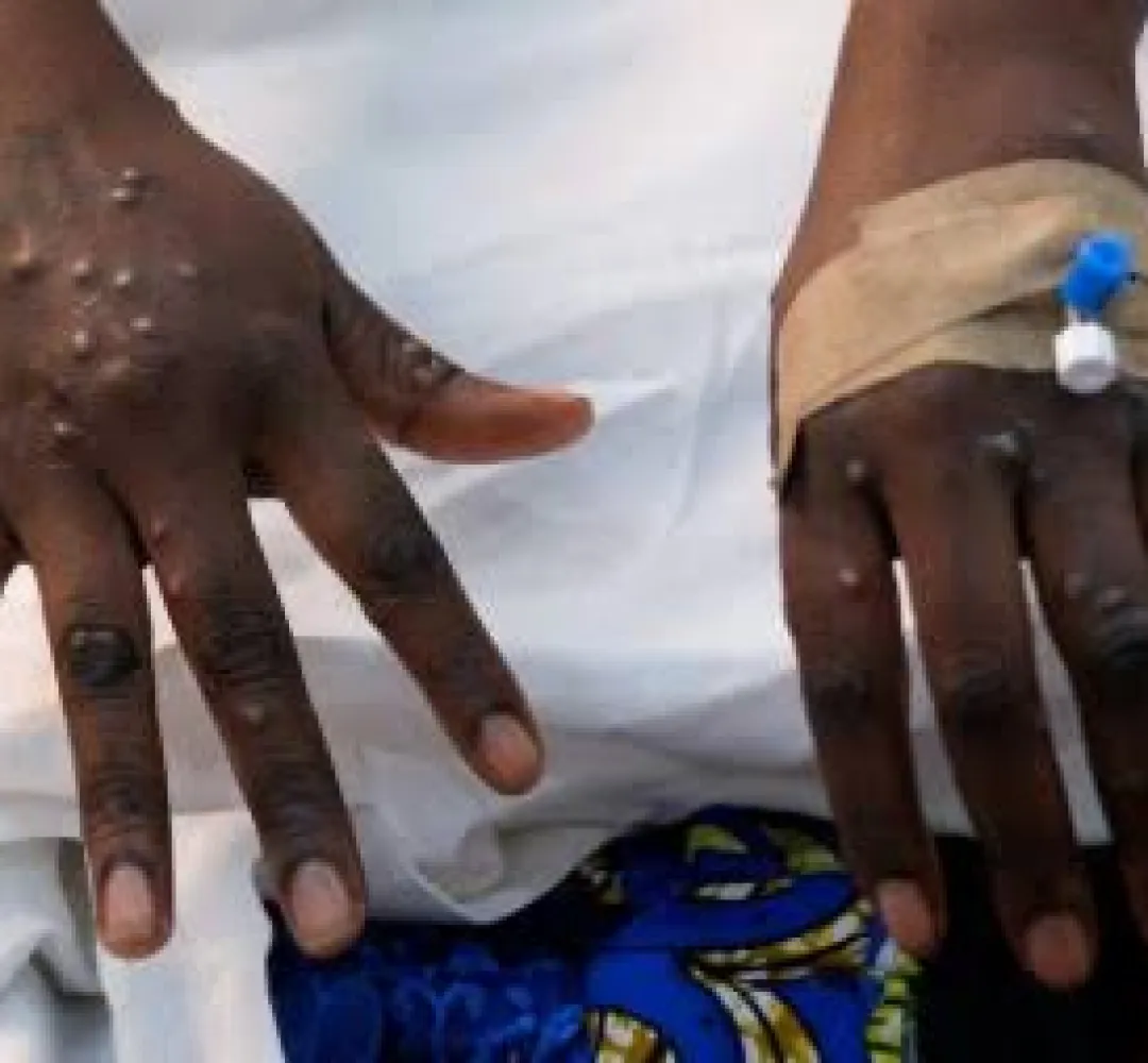 Sierra Leone Reports First Confirmed Case of Mpox