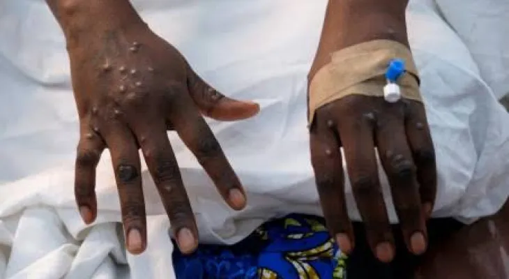 Sierra Leone Reports First Confirmed Case of Mpox