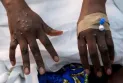 Sierra Leone Reports First Confirmed Case of Mpox