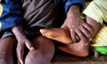 Four Cases of Mpox Virus Confirmed in Sierra Leone