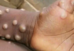 13 New Mpox Cases in Sierra Leone as Total Infections Surpass 4,000