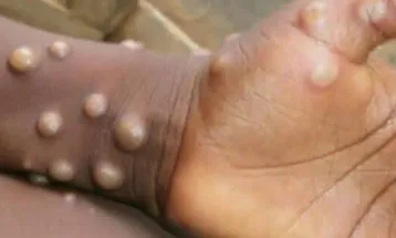 13 New Mpox Cases in Sierra Leone as Total Infections Surpass 4,000